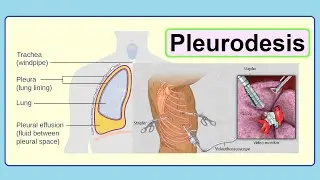pleurodesis