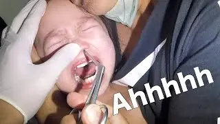 Removing Something Stuck Inside Girl's Nose