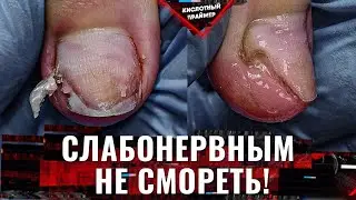 Traumatic onycholysis of nails and fungus😬 Hard trauma of the nail😱 Causes of onycholysis from Ya...