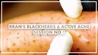 Bran's Blackheads & Active Acne (1st session)