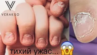Наращивание ногтей акригелем. До/После . Это больно...