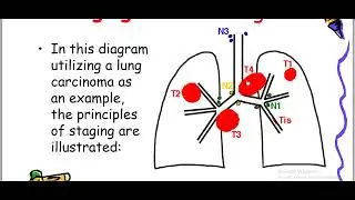 Lung carcinoma