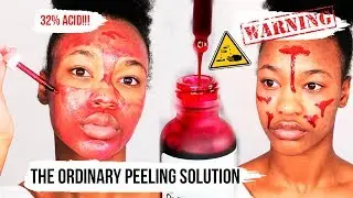I DIDN'T EXPECT THIS / I TRIED THE ORDINARY AHA 30% + BHA 2% PEELING SOLUTION ♡ 