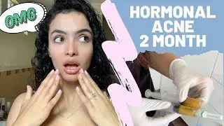 WHAT HAVE I DONE ?| VAMPIRE FACIAL DONT DO IT !! | PRP | BEFORE-AFTER