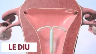 Le DIU: comment ça marche ?