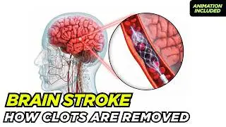 What happens during a stroke? | How brain clots are removed?