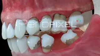 Vídeo 3D Consecuencias de la ausencia dental - Tráiler