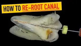 Re-Root Canal Retreatment: Gutta-Percha Removal Step-by-Step (No Guesswork)