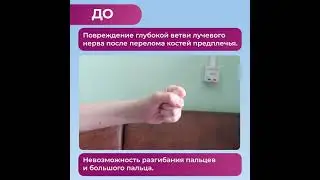 Лучевой нерв. Результат операции в нии микрохирургии.