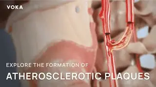 Explore the formation of atherosclerotic plaques
