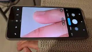 Splinter removal from finger (Phone camera as Magnifier)