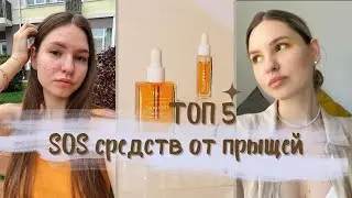 КАК  БЫСТРО ИЗБАВИТЬСЯ ОТ ПРЫЩЕЙ | 5 БЮДЖЕТНЫХ СРЕДСТВ ОТ АКНЕ