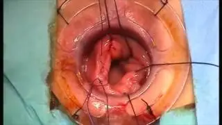 Prof. Dr. Sezai Leventoğlu-TST (tissue-selecting therapy) stapler ile rektosel onarımı