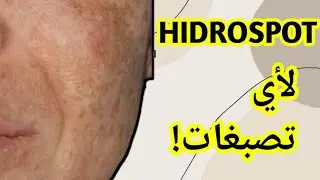 HIDROSPOT لمدة 6 اشهر 🧐النتيجة علاج فاشل😱مرضع او حامل هل تستعمل HIDROSPOT🤔نفس المنتوج و الوصفات 🤫