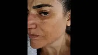 JÁ FIZ DE TUDO E O MELASMA NÃO CLAREIA! VEJA ESSE DEPOIMENTO!