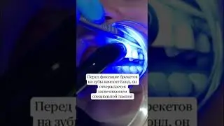 Фиксация брекетов начинается с нанесения протравки на зубы и бонда, который засвечивают