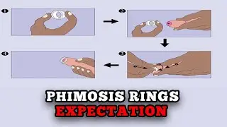 What you should expect from a PHIMOSIS RINGS TREATMENT