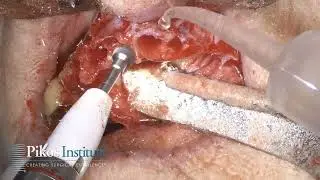 Hybrid Zygomatic Implant Case - Dr. Michael A. Pikos
