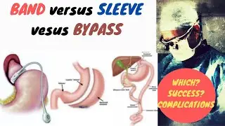 Gastric Band versus Gastric Sleeve versus Gastric Roux en Y Bypass (RYGB)