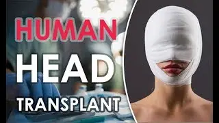 Human Head Transplant 2017 | Dr.Sergio Canavero