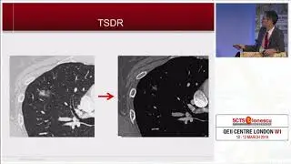 Treatment Strategy for Ground Glass Opacity and Tiny Lung Nodules