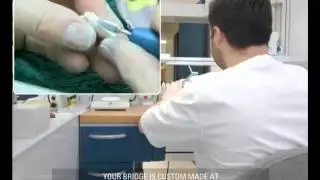 Maryland Bridge - Miskin Ajax Dental