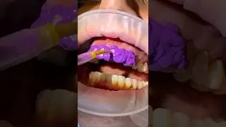 Dentistry is more than a profession; it’s a craft where skillful hands sculpt perfect smiles #veneer