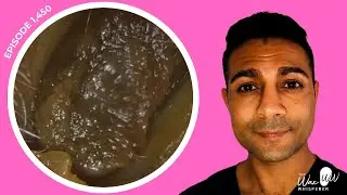 1,450 - Large Ear Wax Plugs Extracted from Both Ears to Reveal Tympanosclerosis