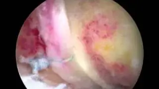 Hip femoroacetabular (FAI) Impingement