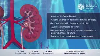 Retirada Duplo J - Dr. Diego Delgado