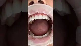 Тотальная реконструкция улыбки