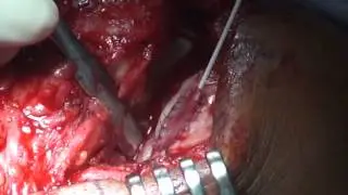 Carticel Cartilage Transplantation Knee (ACI) Dr. Nasar Dr. Berkowitz