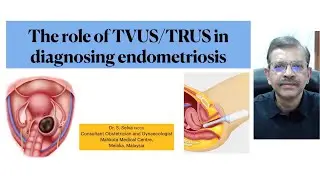 The role of transvaginal and transrectal ultrasound in the diagnosis of endometriosis