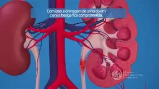 Retirada de cálculo renal com implante duplo J