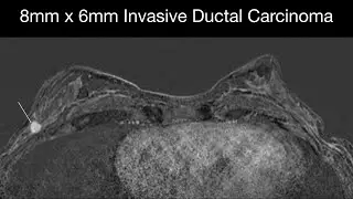 8mm x 6mm Invasive Ductal Carcinoma