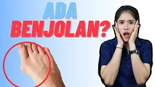 Ibu Jari Kaki Bengkok ke Dalam? Mungkin Ini Penyebabnya! (Bunion) | #HOT