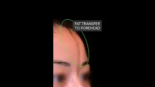 How to fix a depression in the forehead using fat transfer | Dr. Hooman Khorasani