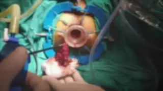 Prof. Dr. Sezai Leventoğlu-TAMIS/Gelpoint Rektal kitle eksizyonu