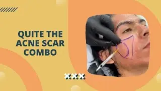 QUITE THE ACNE SCAR COMBO | Dr. Jason Emer 