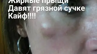 Давить прыщи. Лучшее видео 2022!!! угри сочные прыщи
