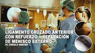 LIGAMENTO CRUZADO ANTERIOR CON REFUERZO + REPARACIÓN DE MENISCO EXTERNO
