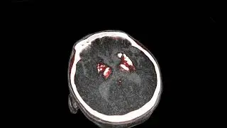 FAHR’S DISEASE (CT-Fahr's syndrome)