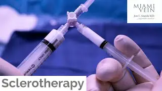 Sclerotherapy Top Things to Know by the Miami Vein Center