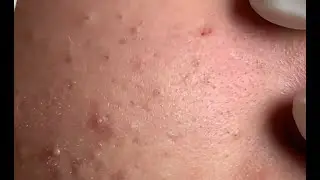 Removendo CRAVOS e ESPINHAS do rosto 😯😯 - Satisfatório