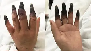 2 Days later after cleaning the house the woman noticed that her fingers were getting black