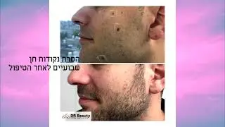 תמונות לפני ואחרי של הטיפולים Dr Beauty