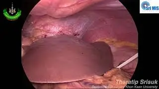 How to do extracorporeal pringle maneuver (Educational UNCUT)