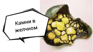 От Кето питания будут камни в желчном? Эфир-215 20.06.23