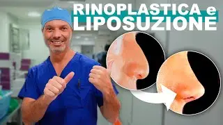 Rinoplastica Ultrasonica e Liposuzione: Una Nuova Tecnica! (Vlog 03)