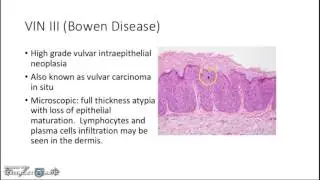 Pathology of Female Reproductive System I: Vulva and Vagina